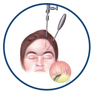 لیفت آندوسکوپیک